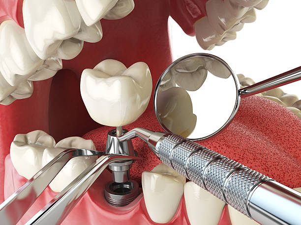 Best Emergency Tooth Extraction in Petal, MS